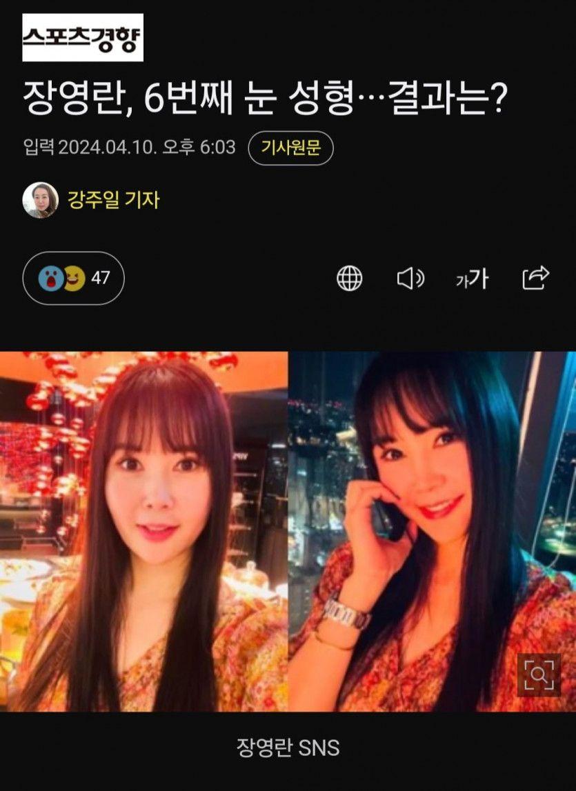 장영란 눈수술 또 했군요0