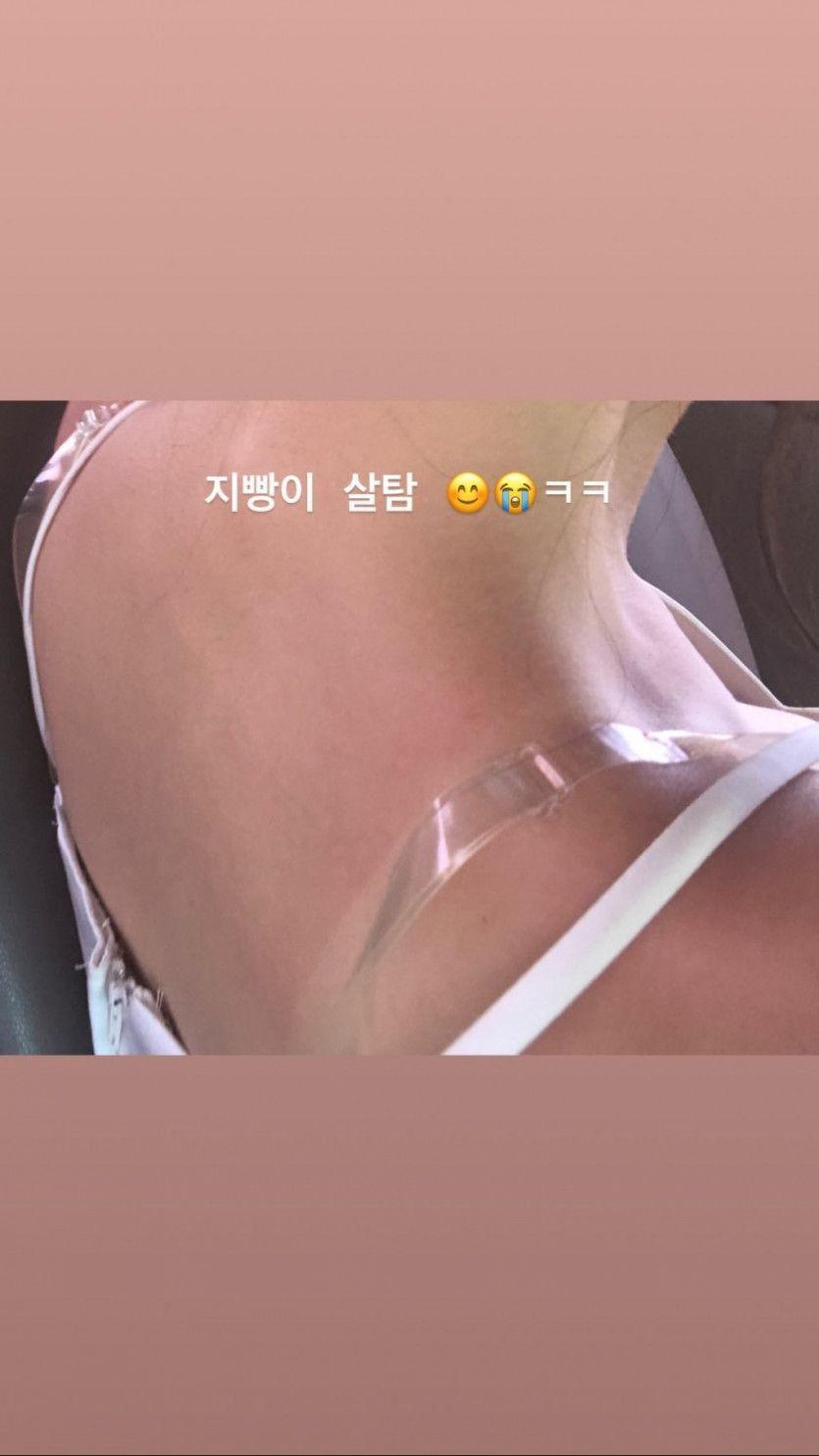 살타서 빨개진 조현2